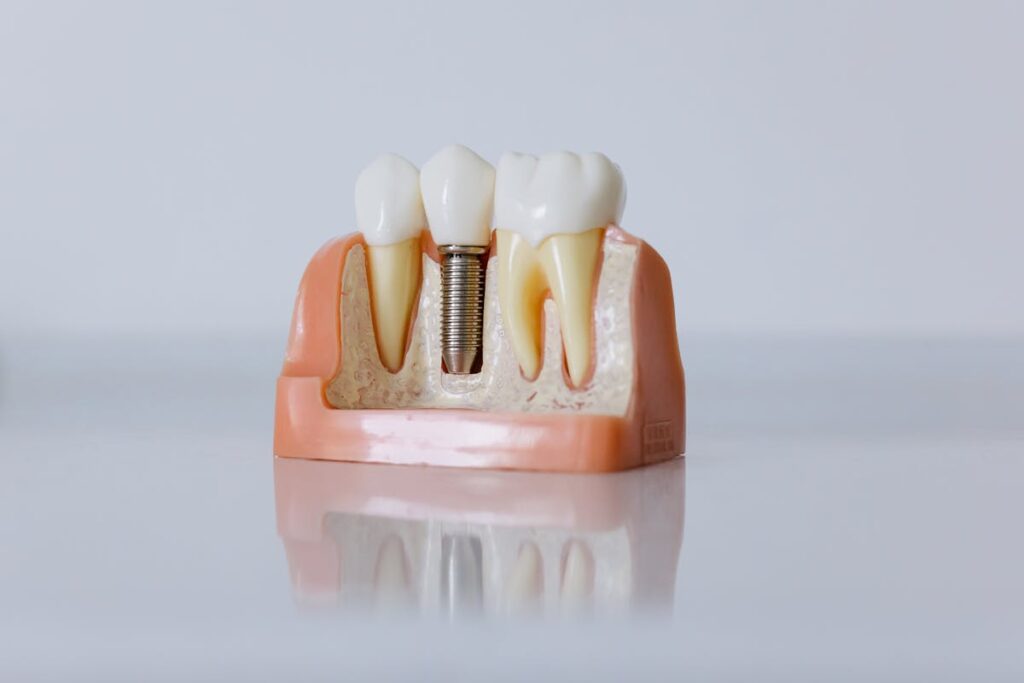 Dental Implants and Prostheses